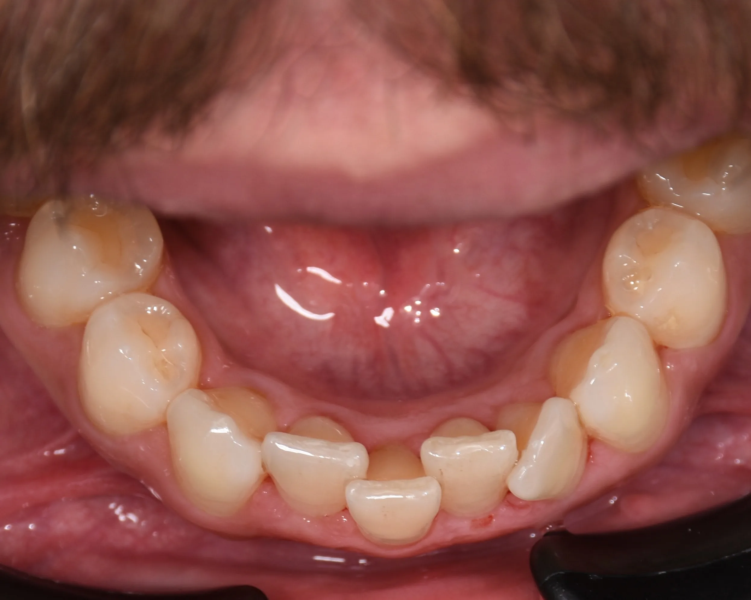 Sarah K. before treatment