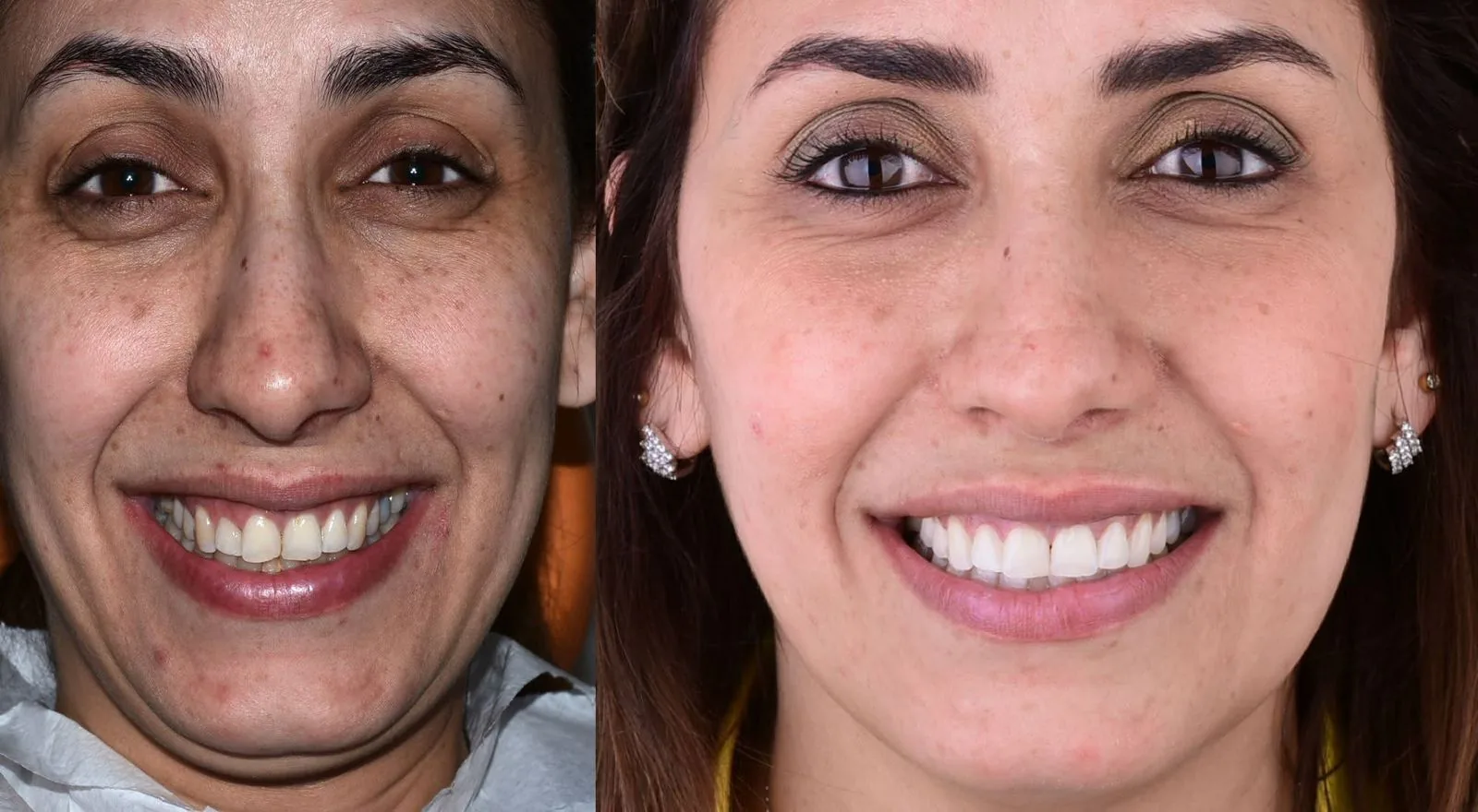 Veneer showcase