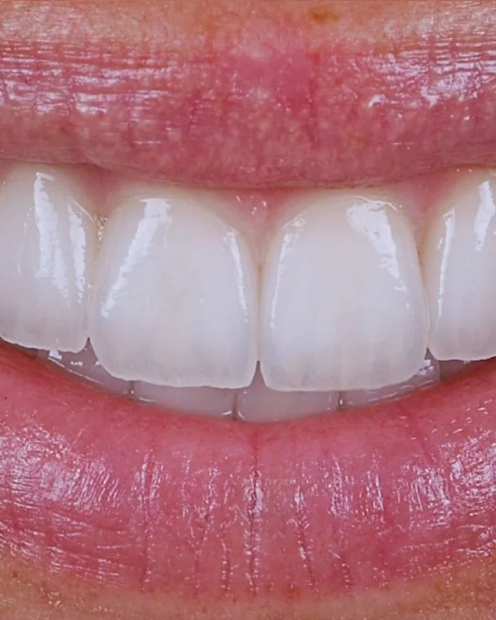 A finished veneer smile at Mineers