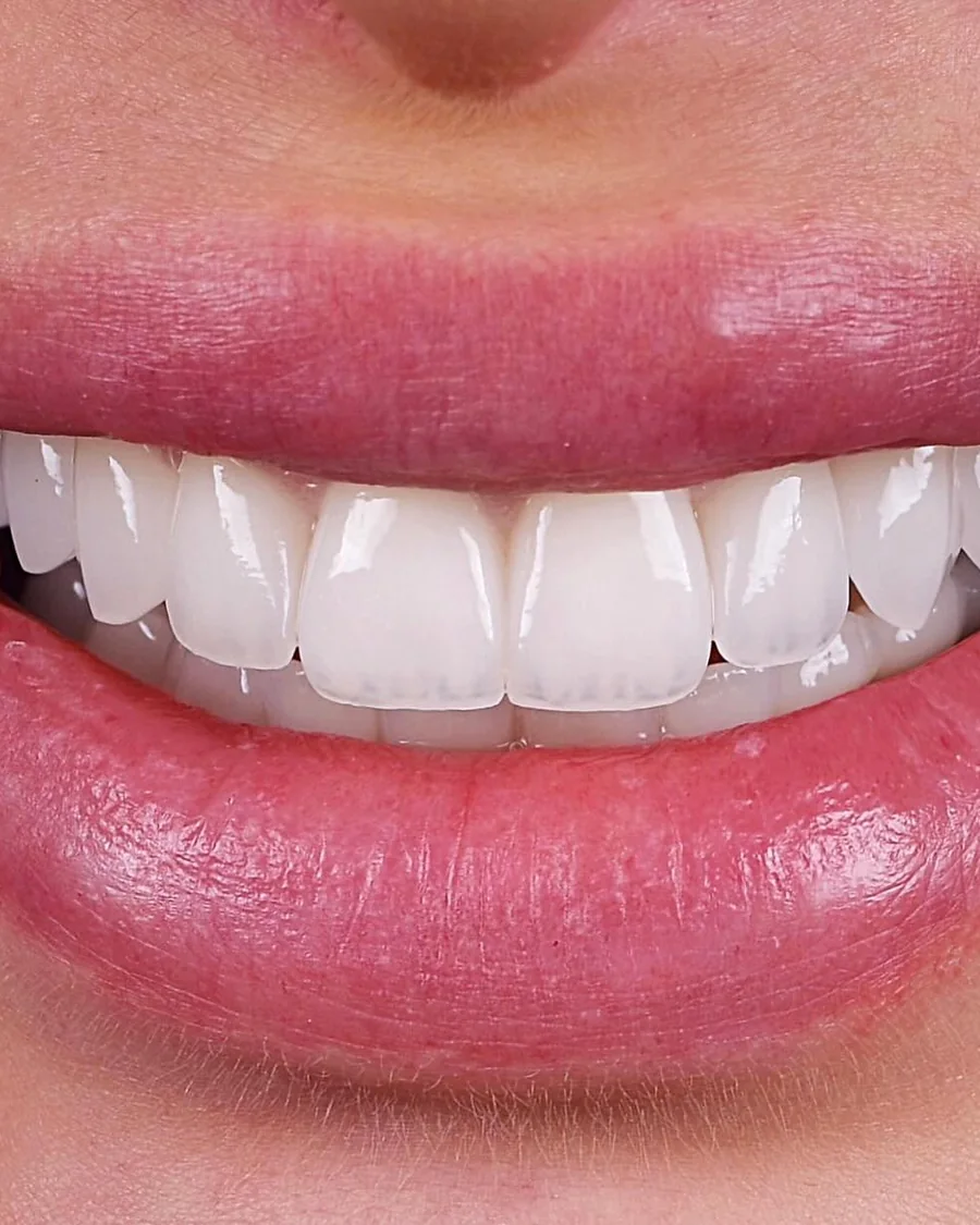 A relaxed smile after porcelain veneers at Mineers