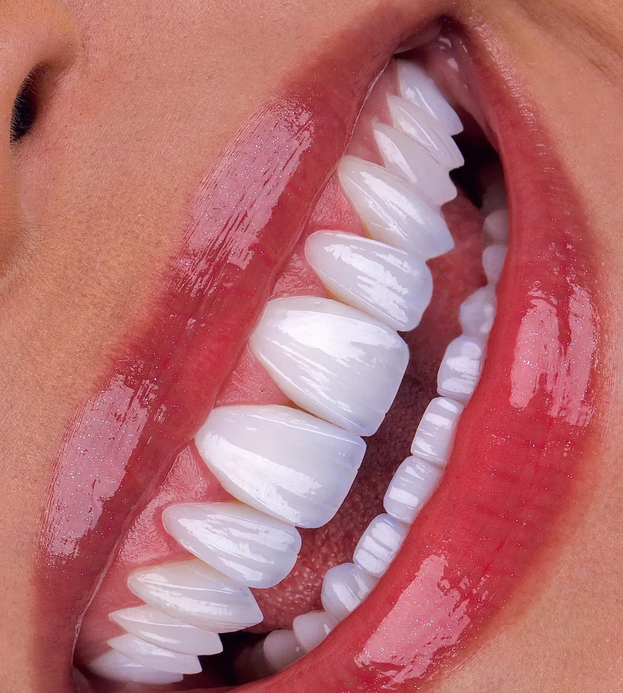 Full Upper Veneer Case — porcelain veneers result at Mineers Smile Center Beirut, Lebanon