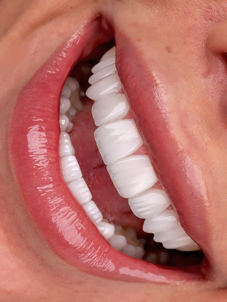 Lateral Smile View — porcelain veneers result at Mineers Smile Center Beirut, Lebanon