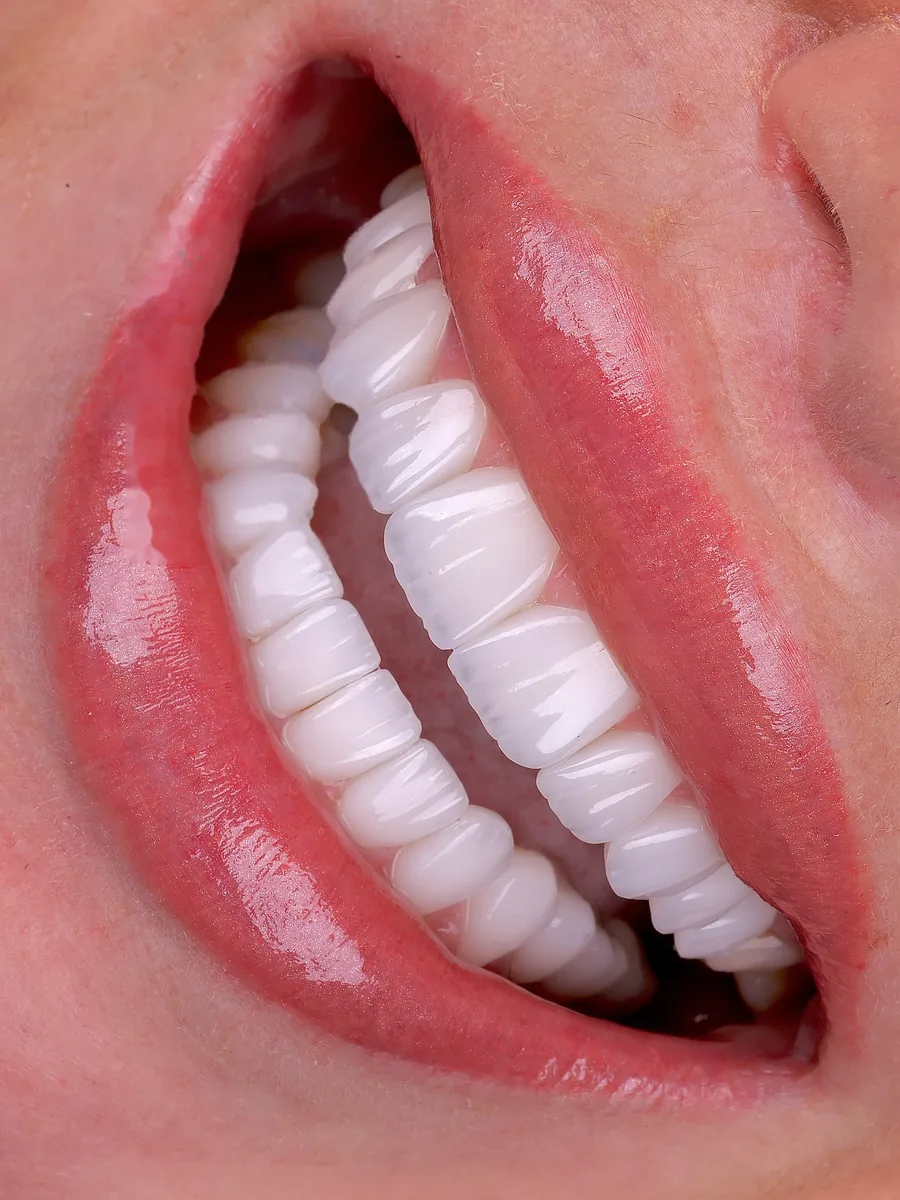 Full Arch Result — porcelain veneers result at Mineers Smile Center Beirut, Lebanon