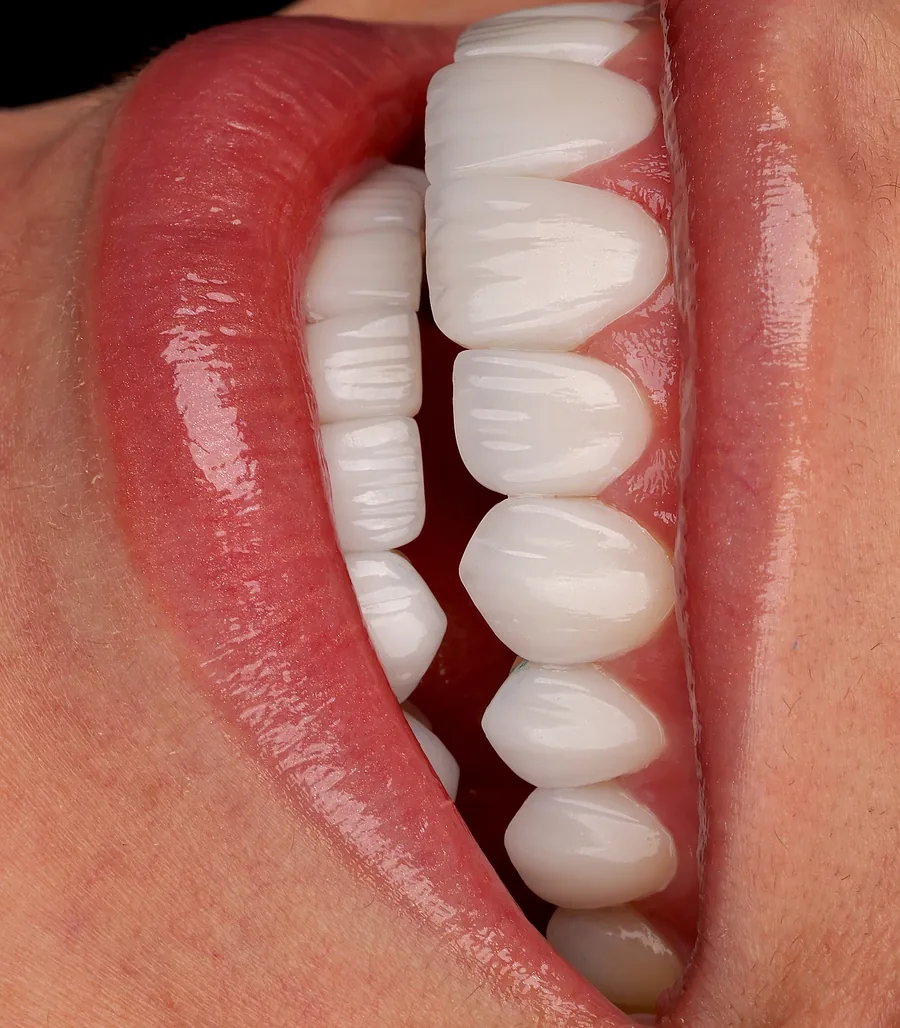 Detailed Surface Texture — smile design result at Mineers Smile Center Beirut, Lebanon