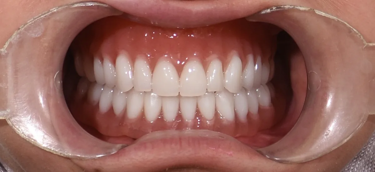 Veneer showcase