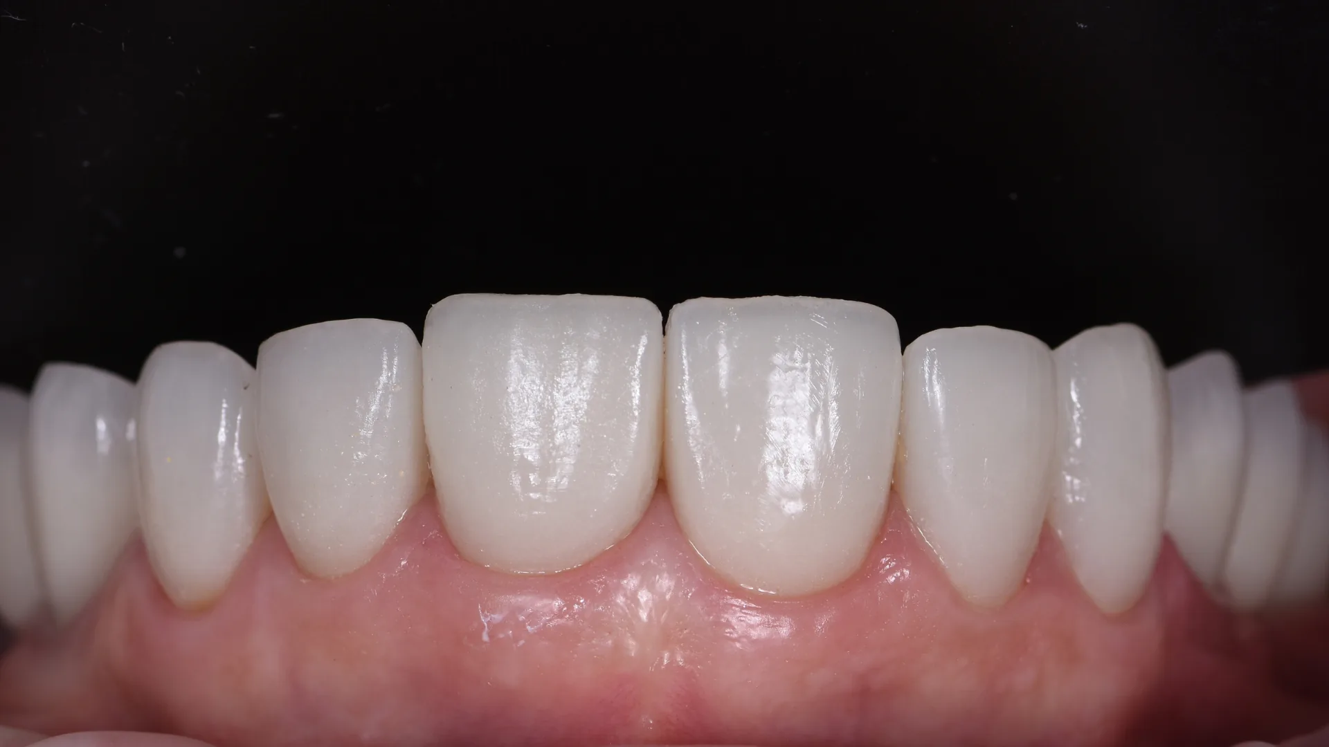 Veneer showcase
