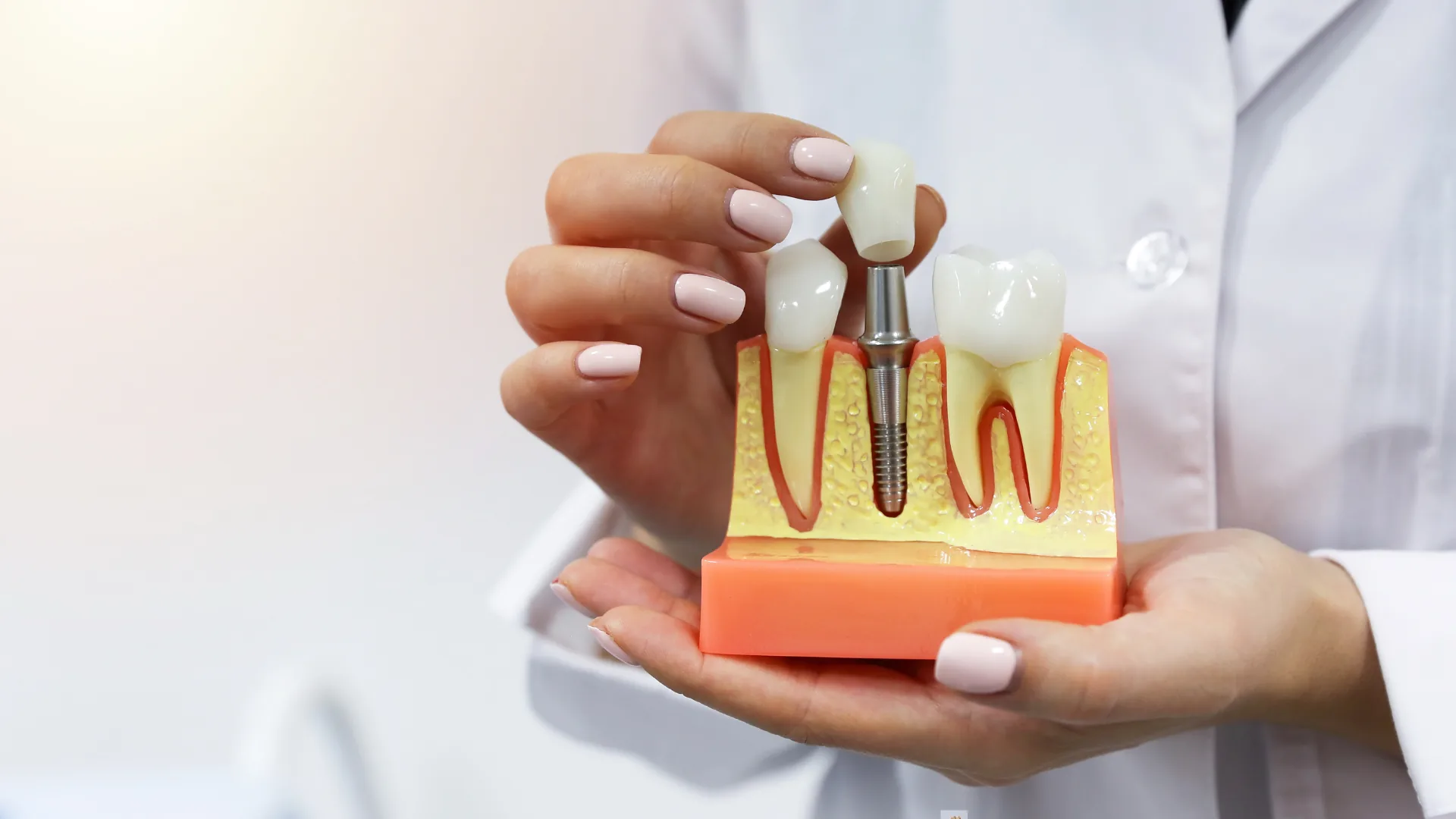 Dental implants treatment at Mineers Smile Center Beirut Lebanon